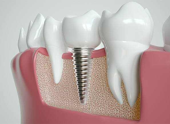Zahnarztpraxis Buchbinder Implantate